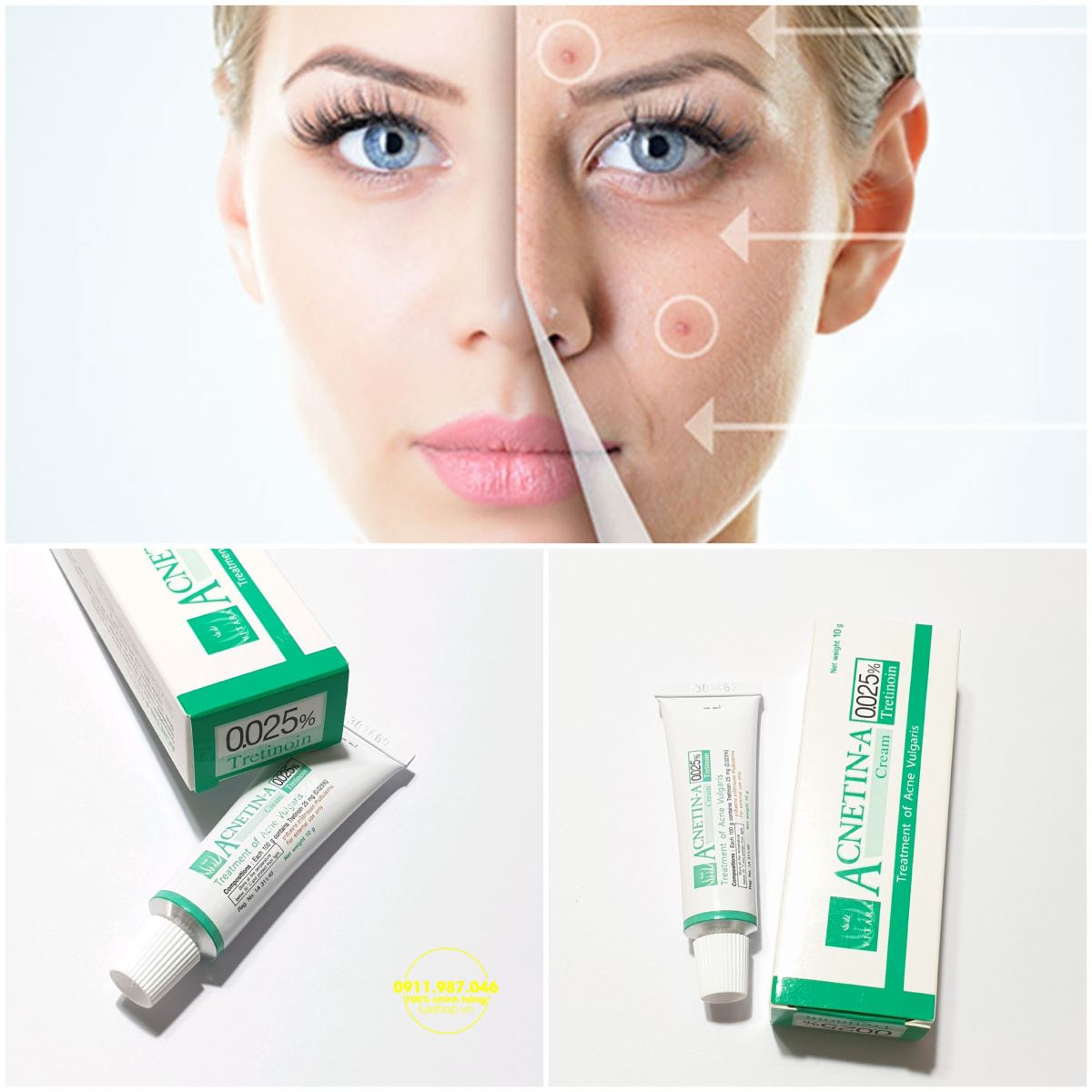 Thuốc Vitara Acnetin-A 0.025 Tretinoin chuyên đặc trị mụn bọc mụn ẩn (Thái Lan)