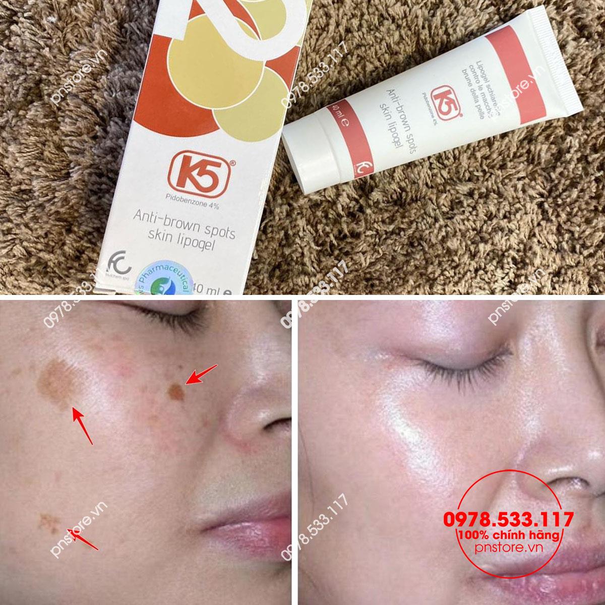 Kem trị nám K5 Anti - Brown Spots Skin Lipogel chính hãng